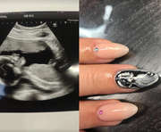 Nehty s ultrazvukovm snmkem